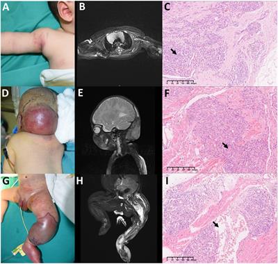 Treatment experience for different risk groups of Kaposiform hemangioendothelioma